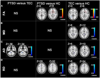 White Matter Abnormalities in Patients With Typhoon-Related Posttraumatic Stress Disorder